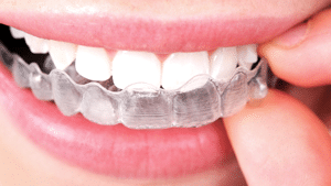 Rubber Band Wear - Orthodontist Vancouver WA, Braces and Invisalign